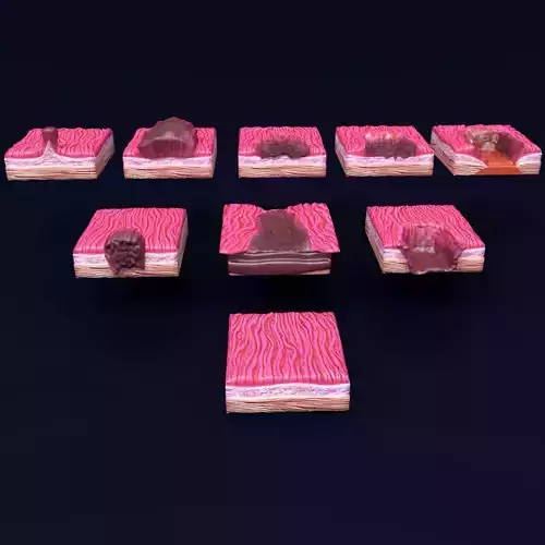 Gastric stomach cancer stages labelled