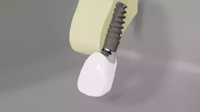 Dental implant crown