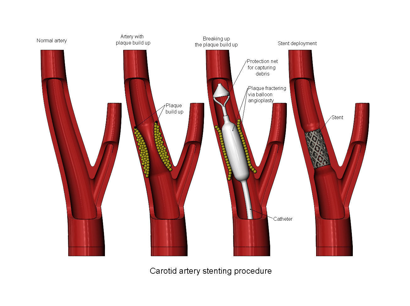 3d printable  Carotid artery stenting procedure diorama 3D print model_1