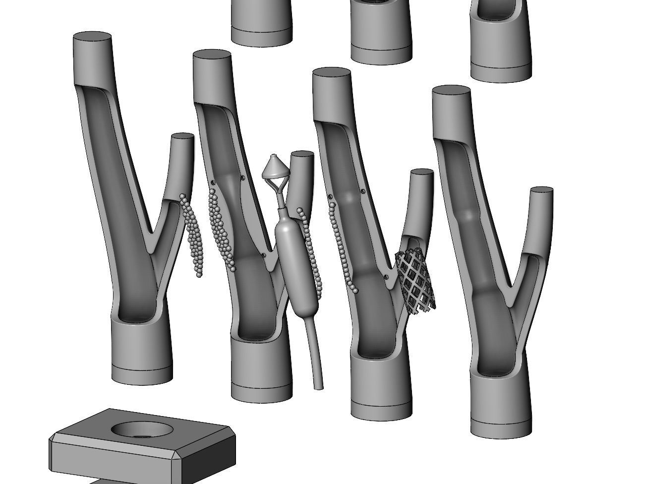 3d printable  Carotid artery stenting procedure diorama 3D print model_8