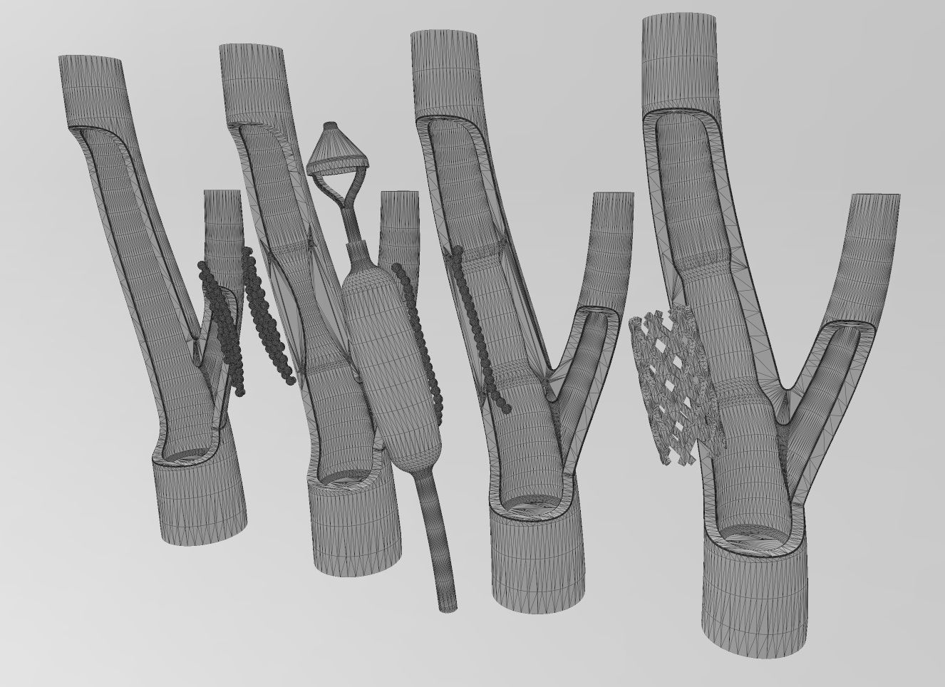 3d printable  Carotid artery stenting procedure diorama 3D print model_15
