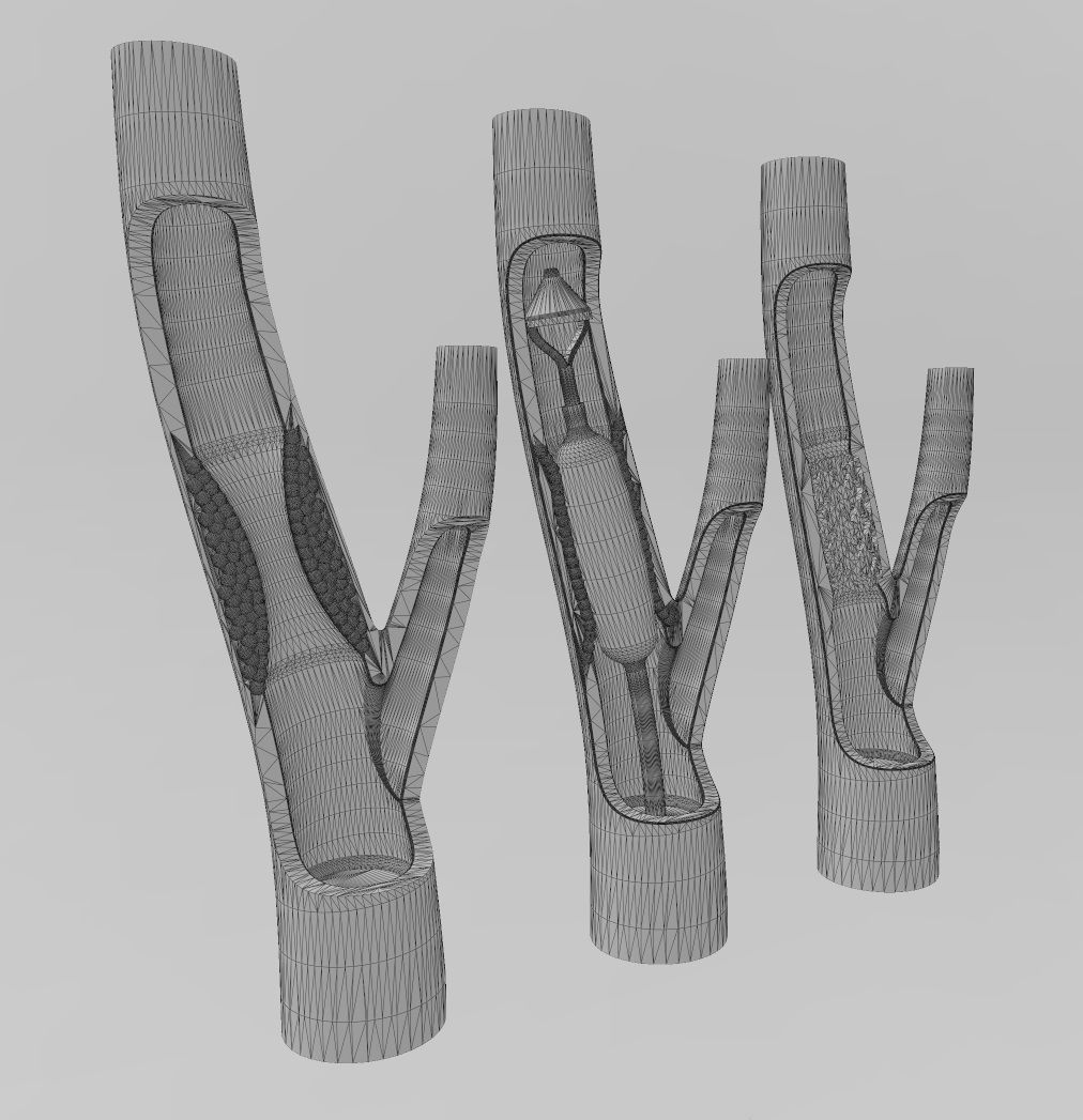 3d printable  Carotid artery stenting procedure diorama 3D print model_13