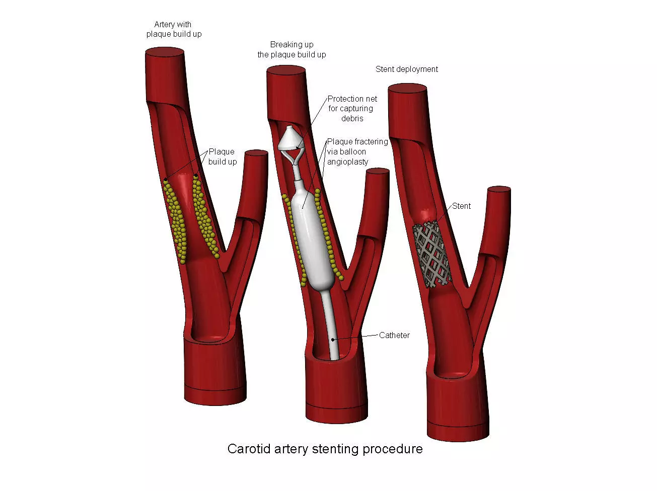 3d printable  Carotid artery stenting procedure diorama 3D print model_0