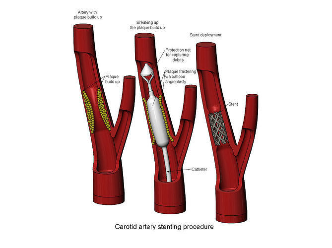 3d printable  Carotid artery stenting procedure diorama 3D print model