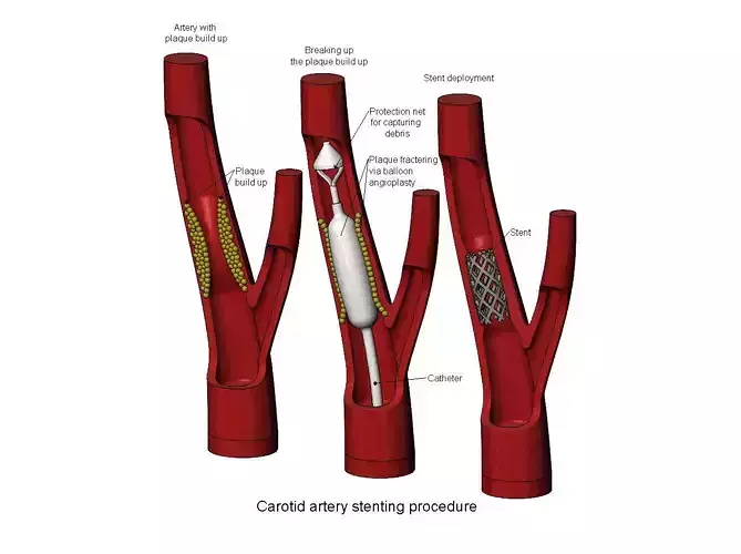 3d printable  Carotid artery stenting procedure diorama 3D print model