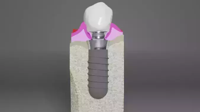 Peri-implant region - Anatomy