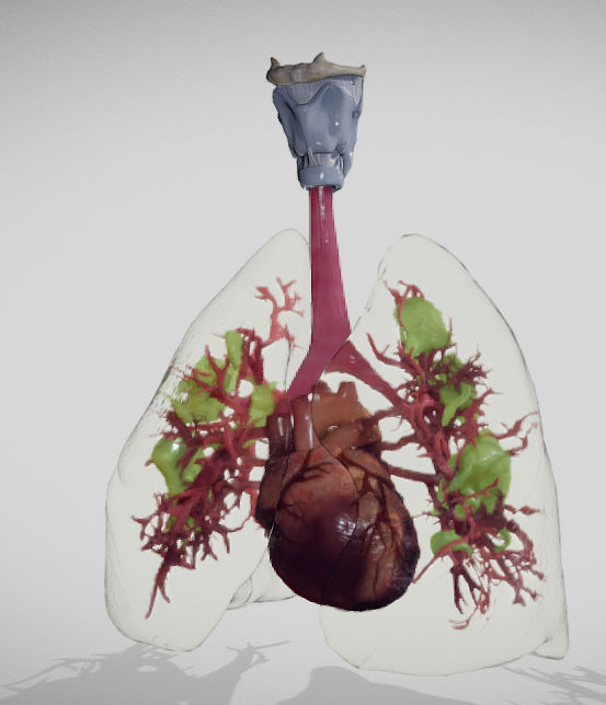 Covid 19 Lung disease Version2 Low-poly 3D model_5