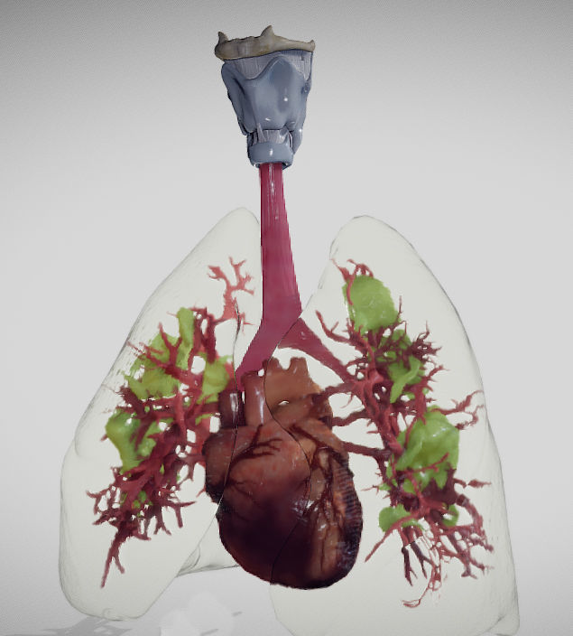 Covid 19 Lung disease Version2 Low-poly 3D model_3