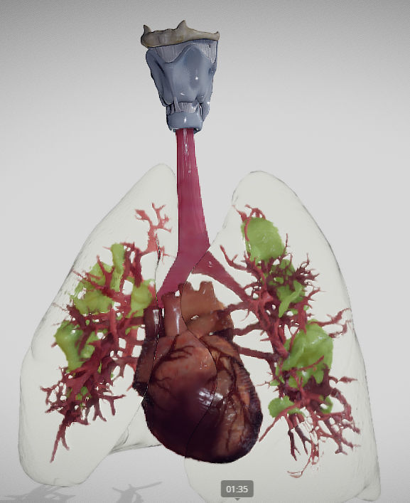 Covid 19 Lung disease Version2 Low-poly 3D model_4