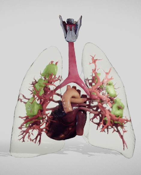 Covid 19 Lung disease Version2 Low-poly 3D model_10