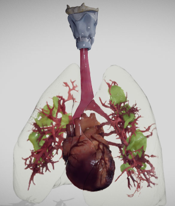 Covid 19 Lung disease Version2 Low-poly 3D model_2