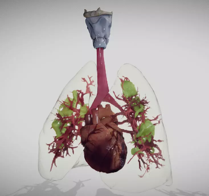 Covid 19 Lung disease Version2 Low-poly 3D model_0