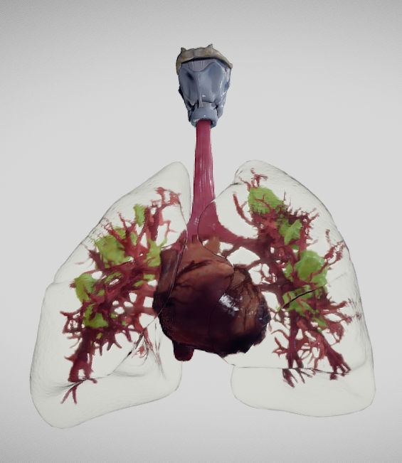 Covid 19 Lung disease Version2 Low-poly 3D model_12