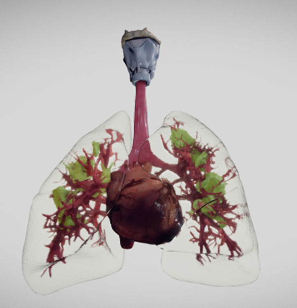 Covid 19 Lung disease Version2 Low-poly 3D model_13
