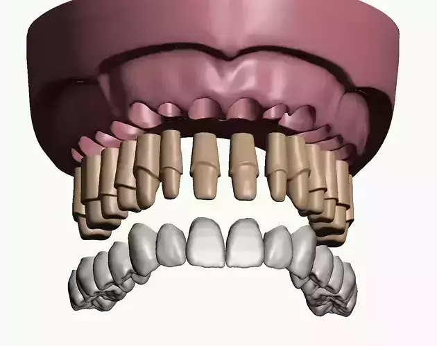 Maxillary dental model prepped dies and crowns 3D print model
