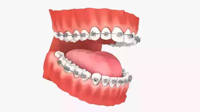 Mouth Teeth Set Braces Brackets