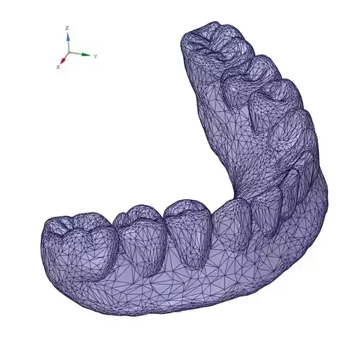 dental prosthesis - denture