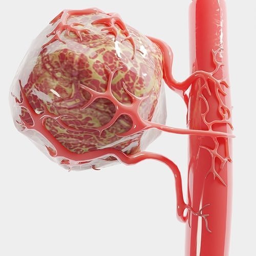 Vessel Tumor 3D model