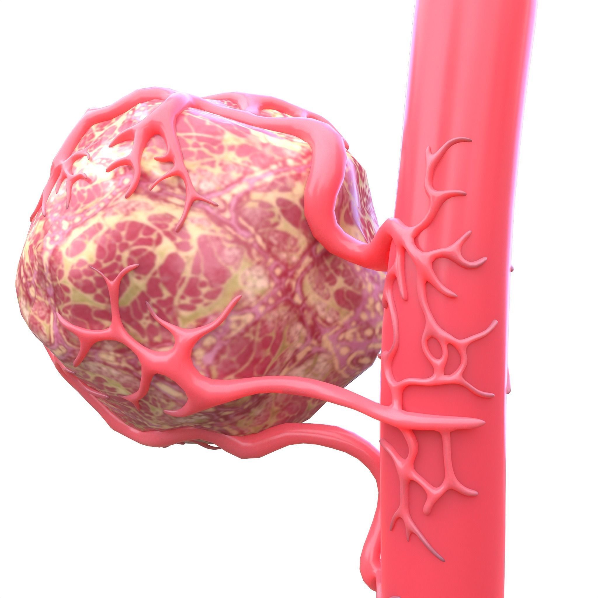 Tumor with Vessels Low-poly 3D model_3