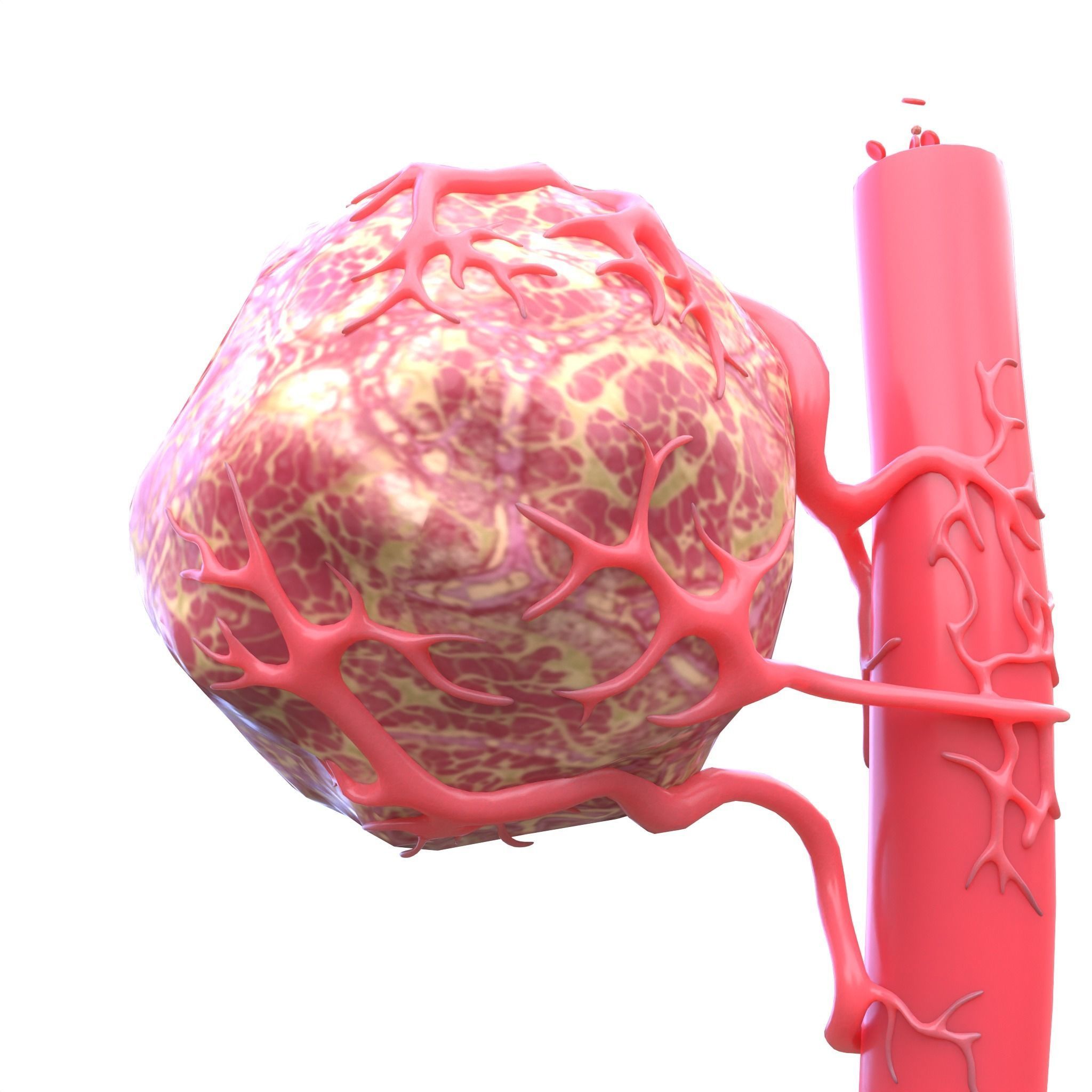 Tumor with Vessels Low-poly 3D model_4