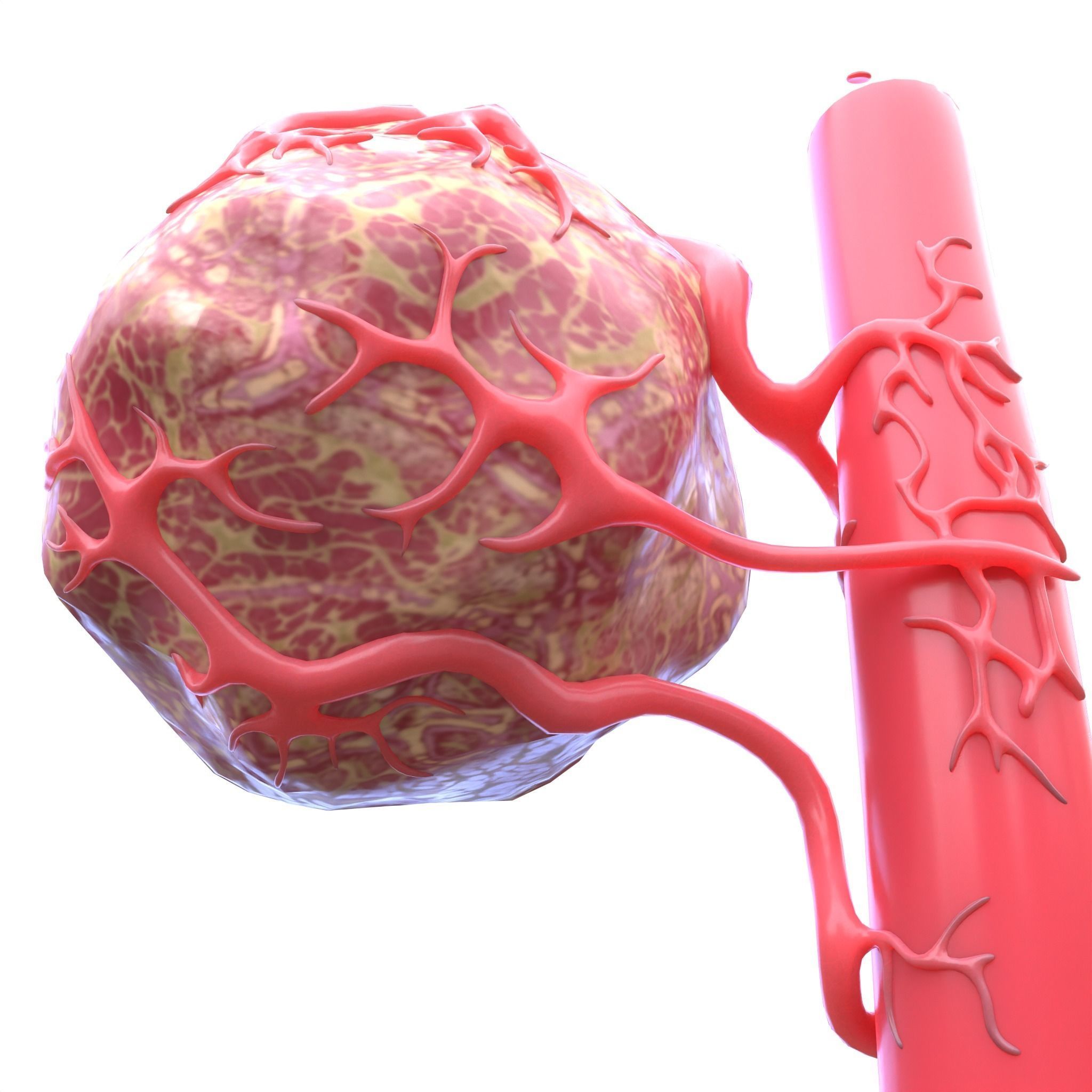 Tumor with Vessels Low-poly 3D model_2