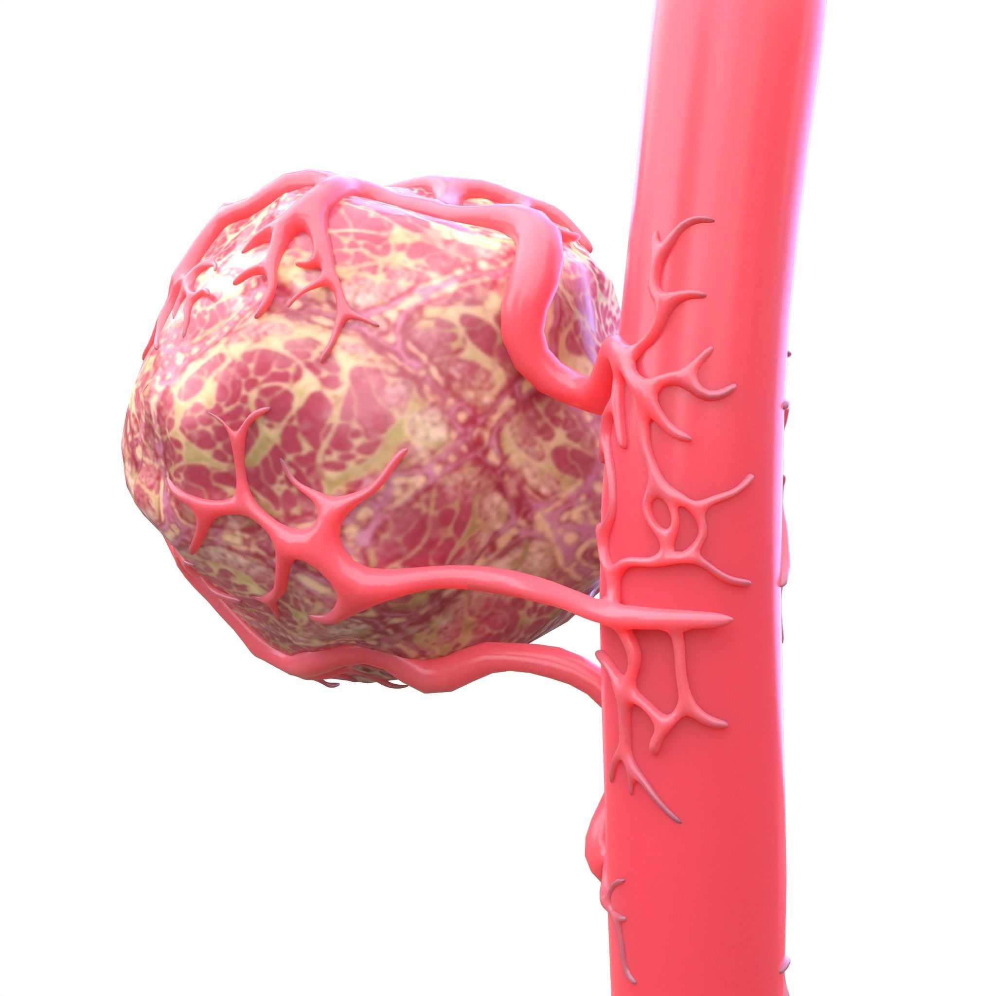 Tumor with Vessels Low-poly 3D model_5