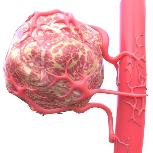 Tumor with Vessels Low-poly 3D model