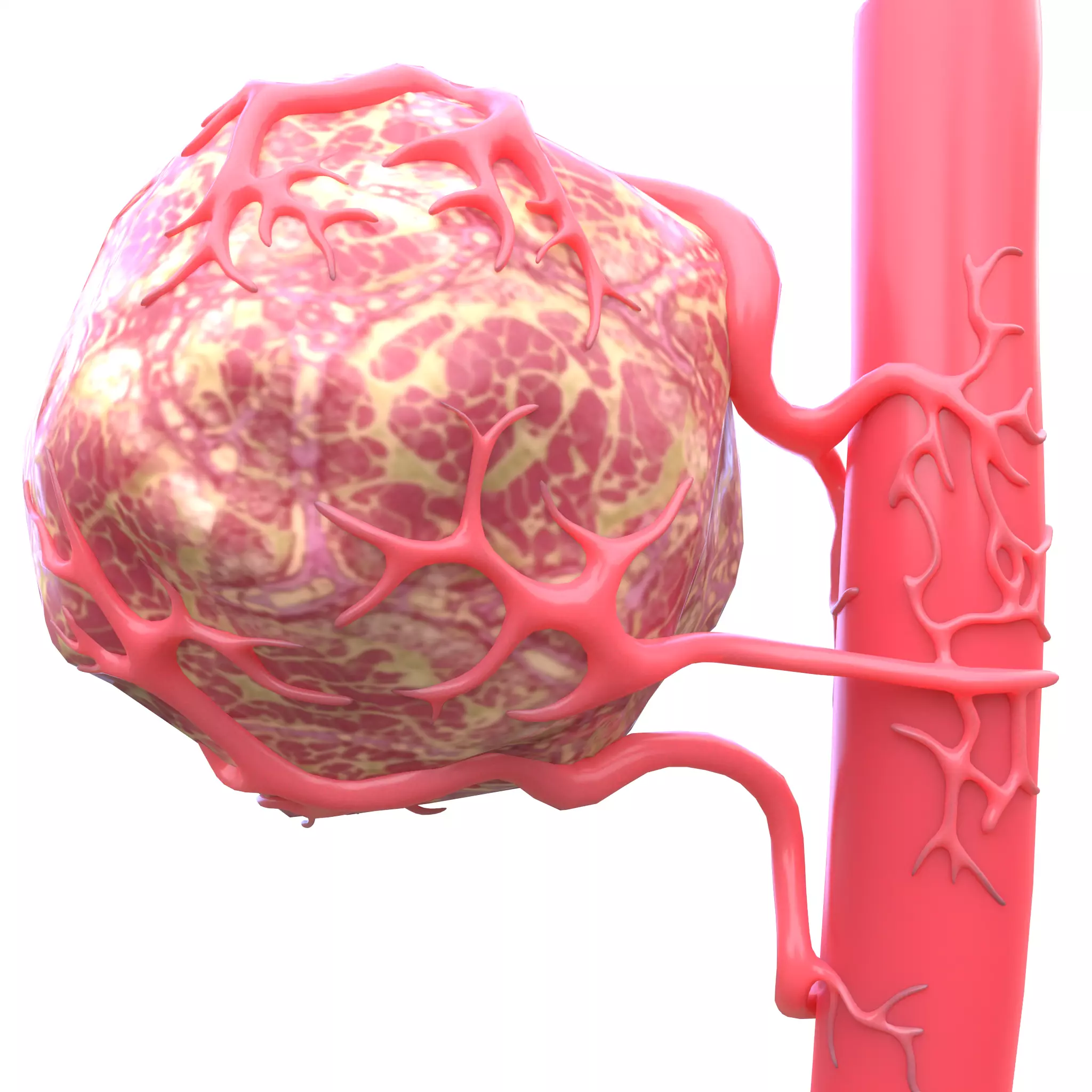 Tumor with Vessels Low-poly 3D model_0