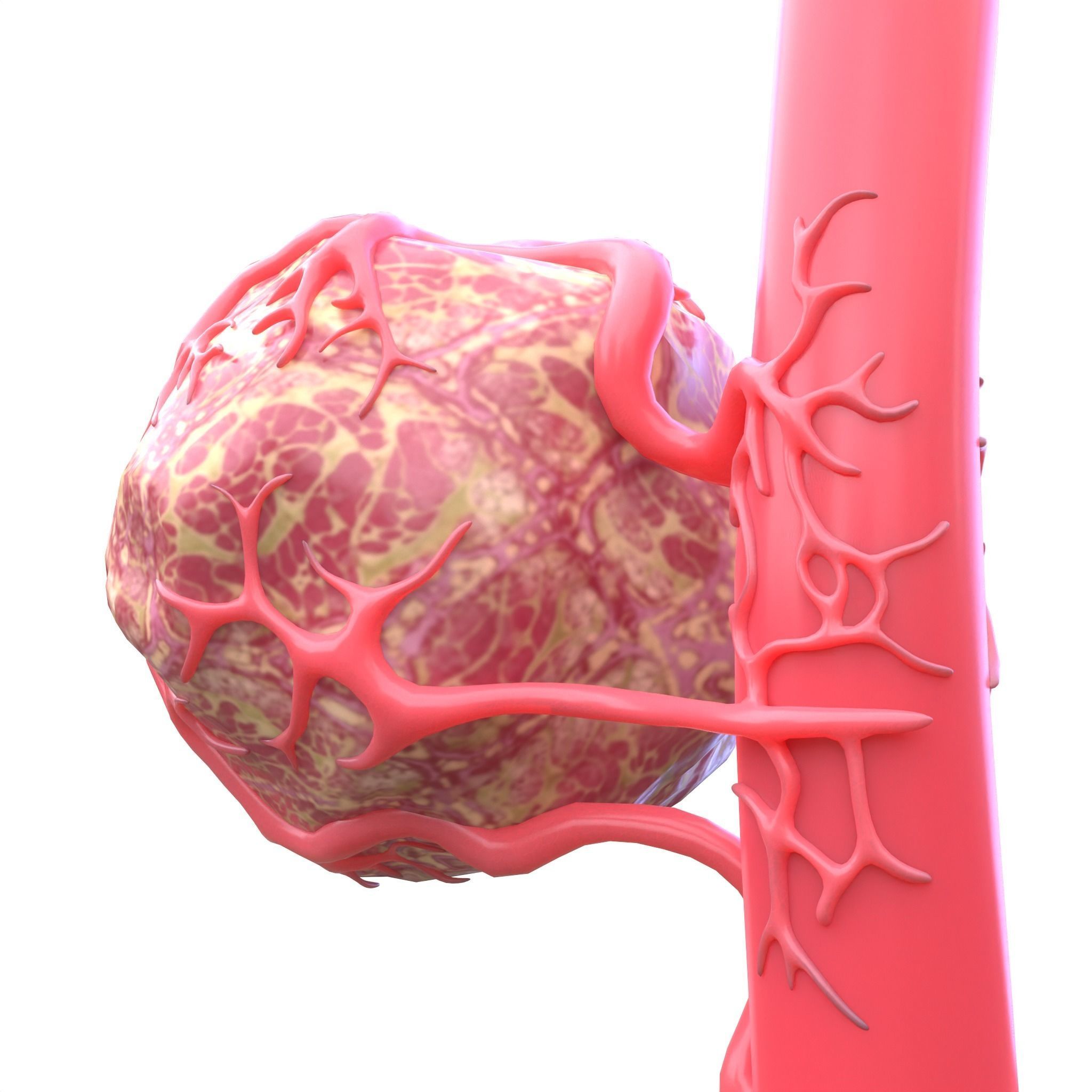 Tumor with Vessels Low-poly 3D model_1