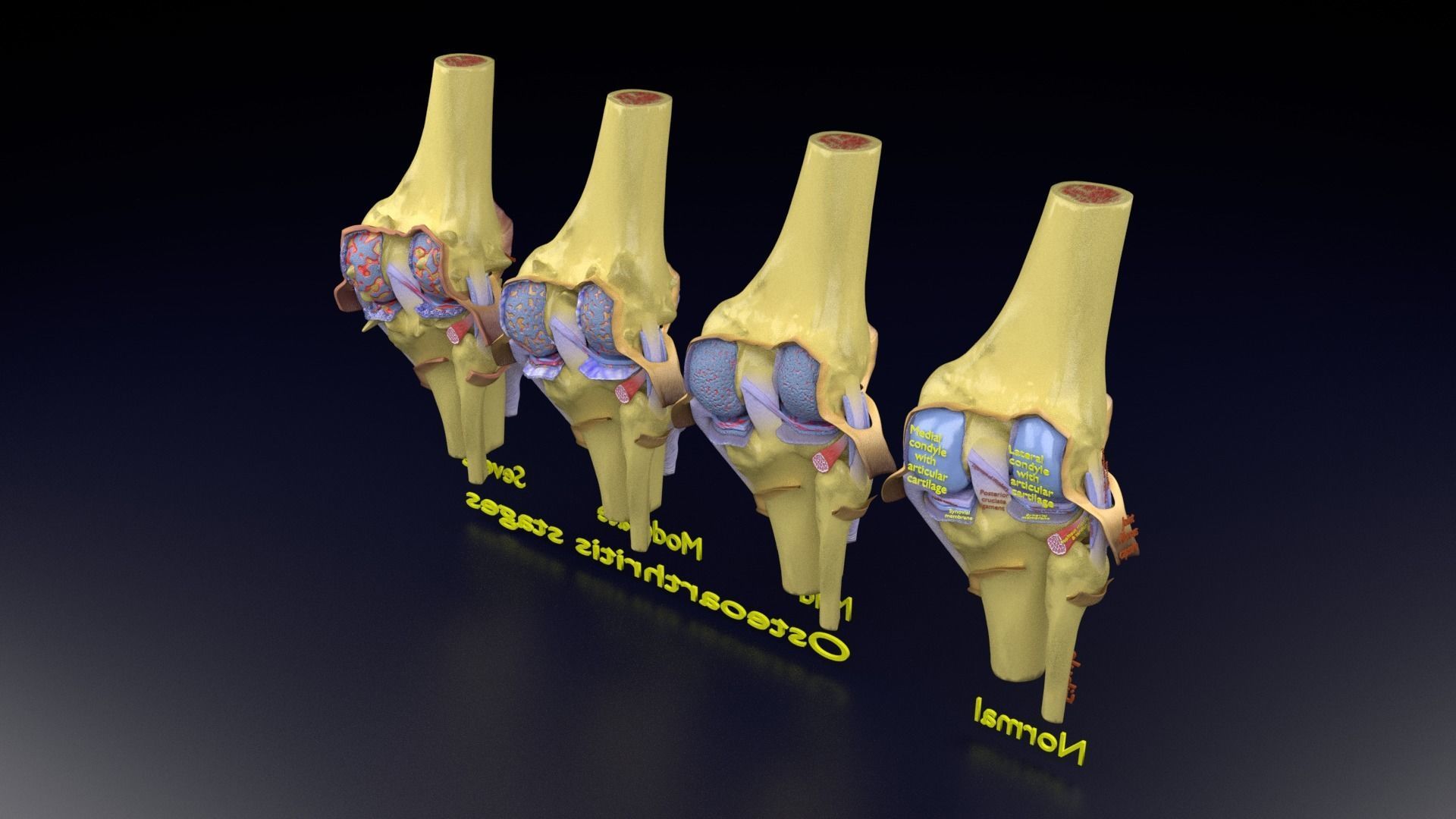 Osteoarthritis stages 3D model_132