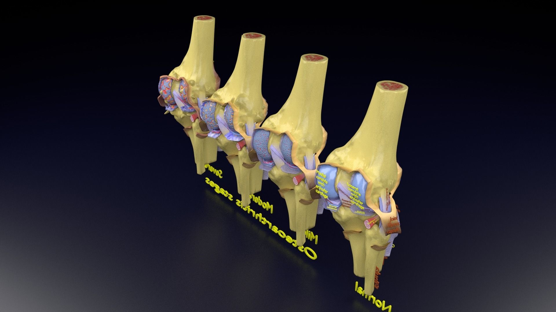 Osteoarthritis stages 3D model_131