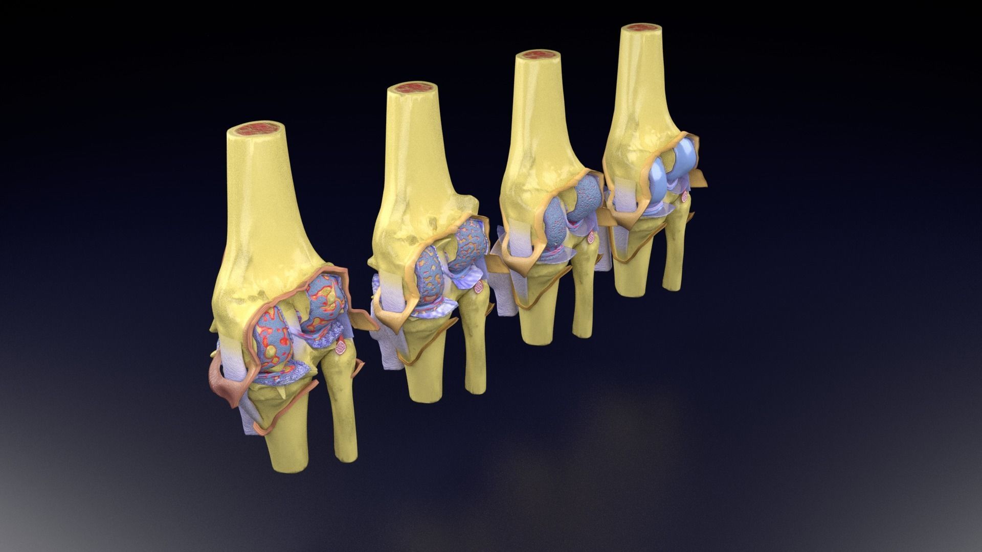 Osteoarthritis stages 3D model_64