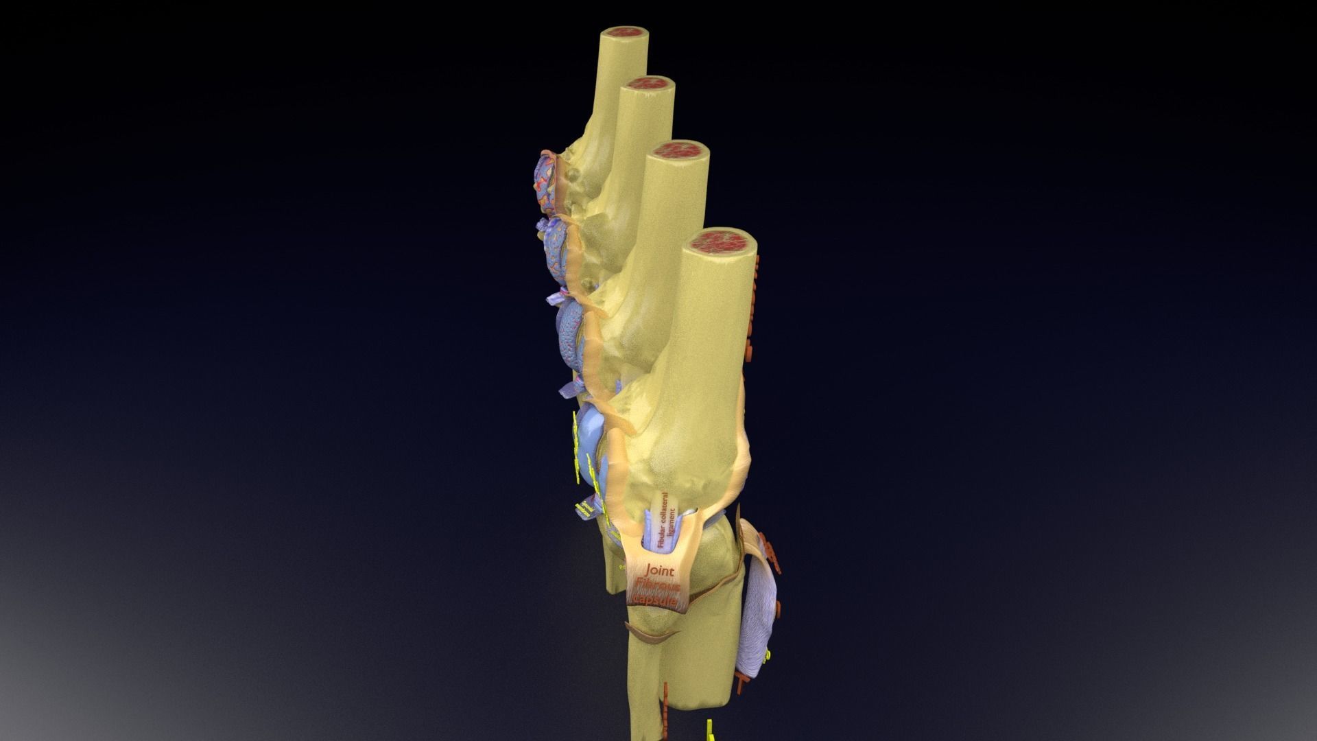 Osteoarthritis stages 3D model_125