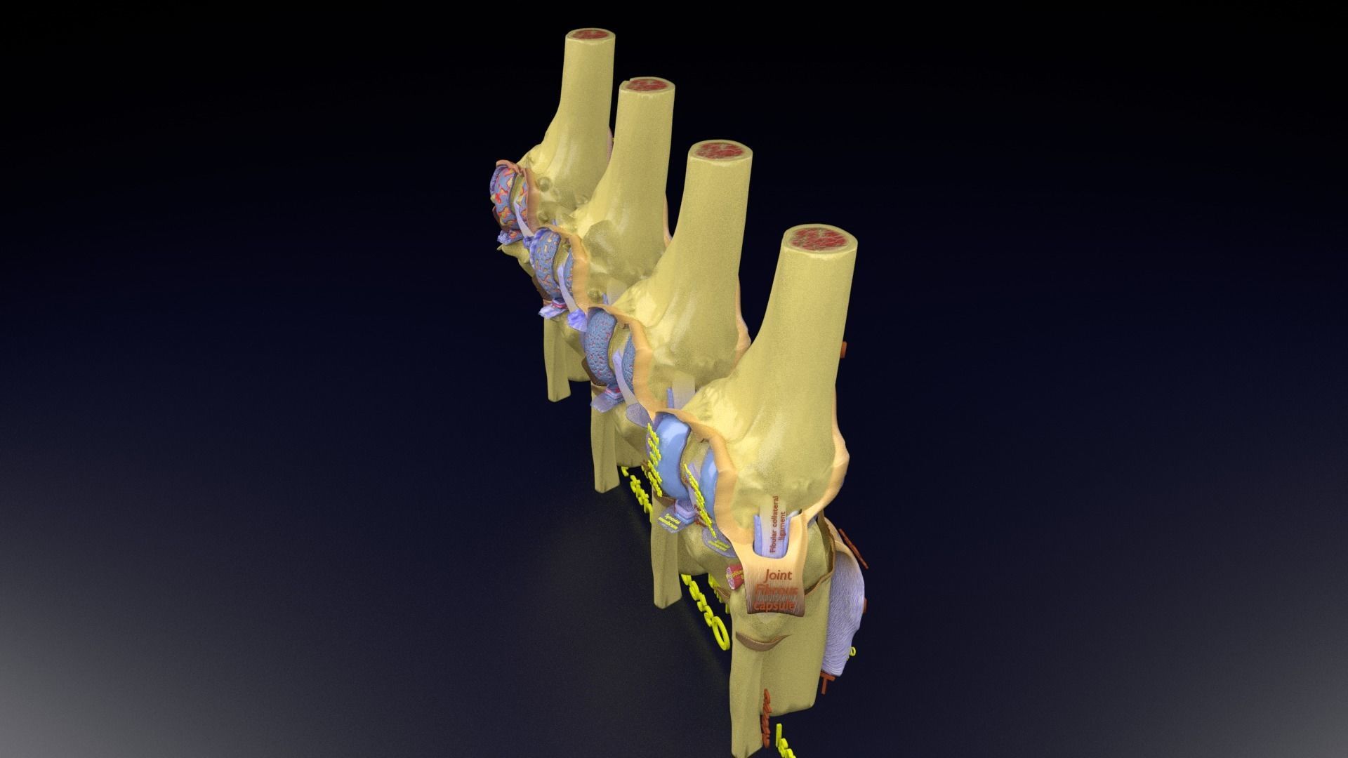 Osteoarthritis stages 3D model_127