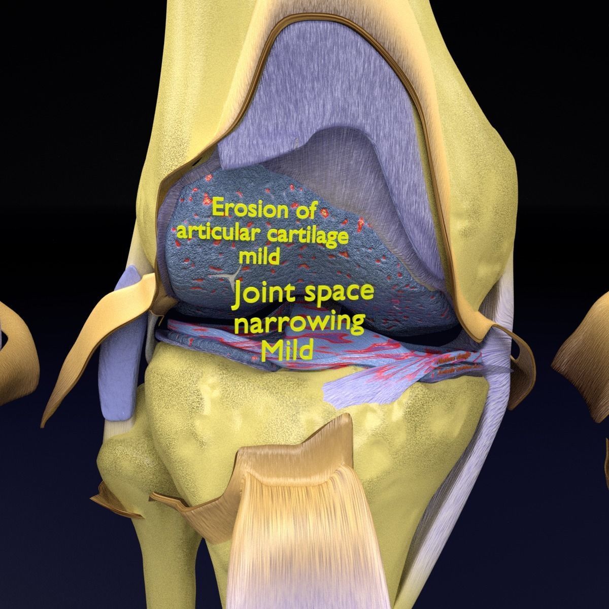 Osteoarthritis stages 3D model_26