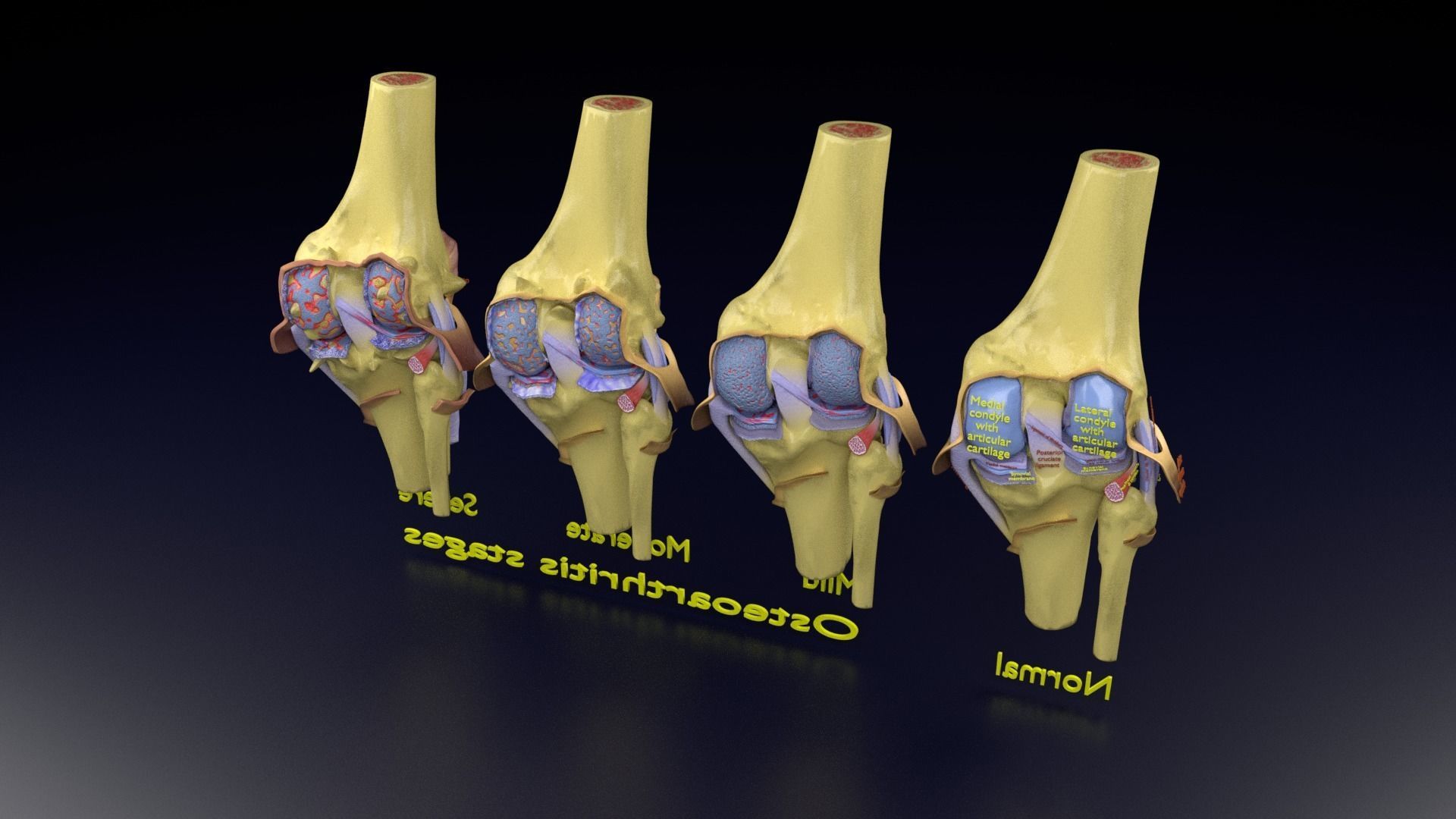 Osteoarthritis stages 3D model_140