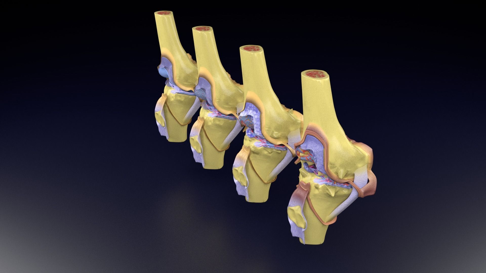 Osteoarthritis stages 3D model_81