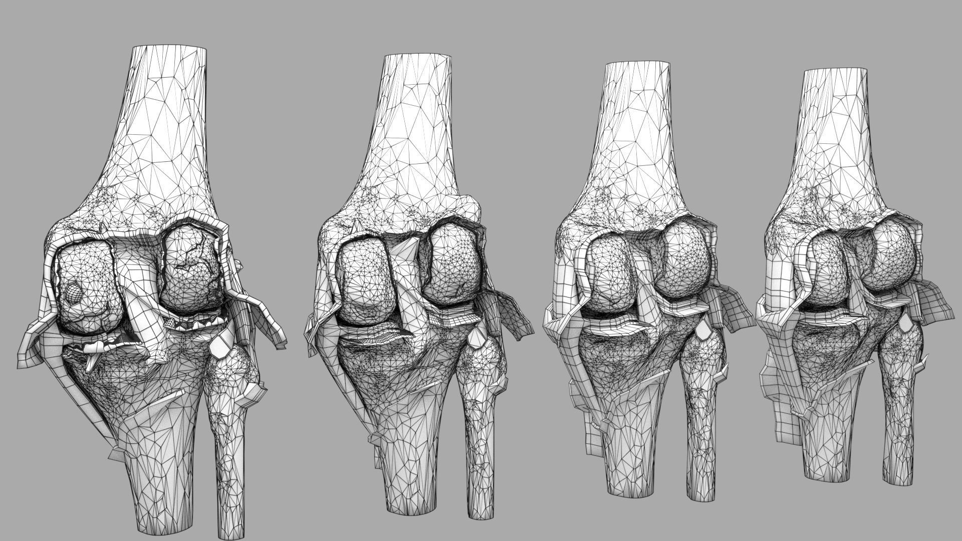 Osteoarthritis stages 3D model_33