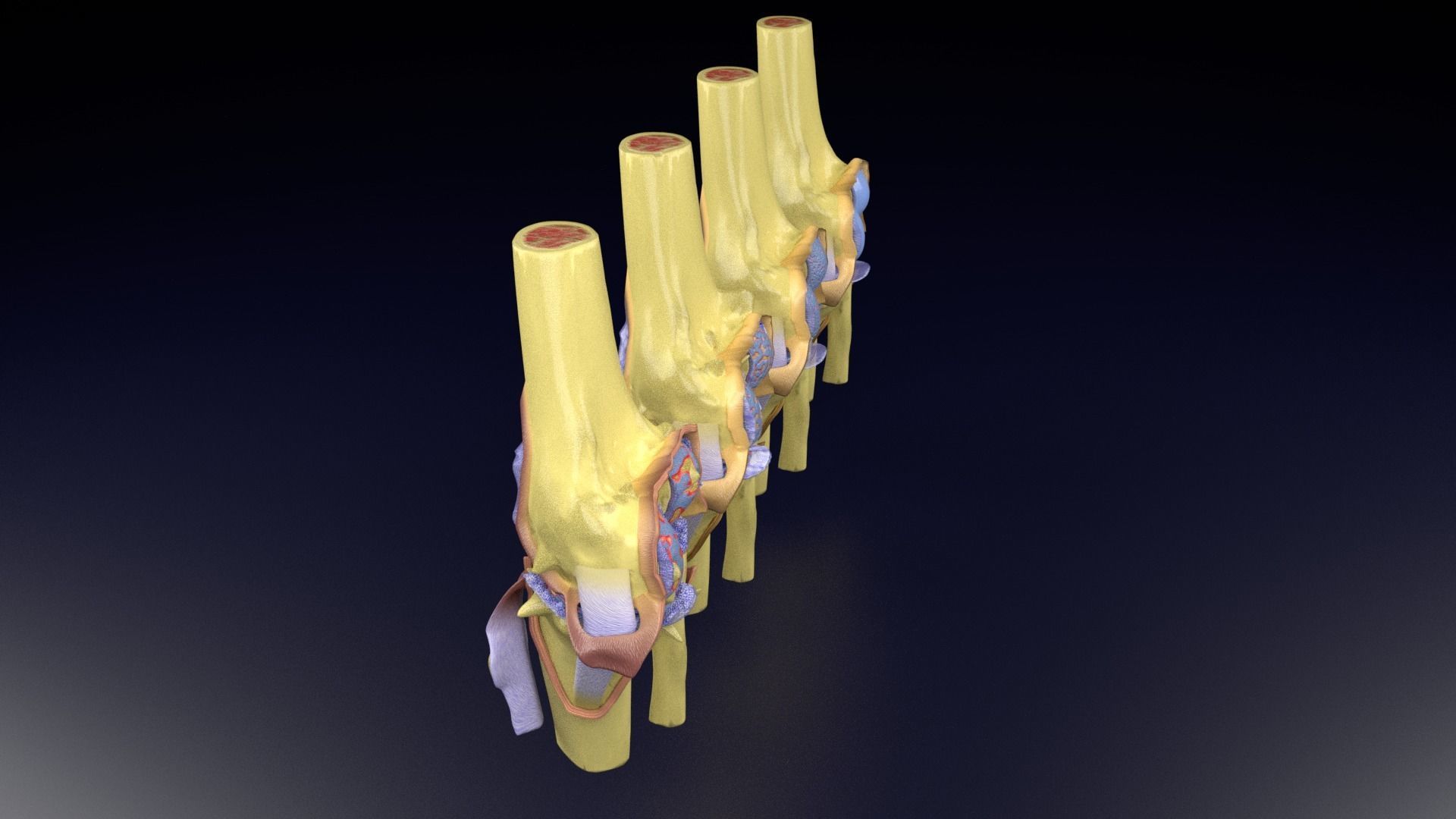 Osteoarthritis stages 3D model_70