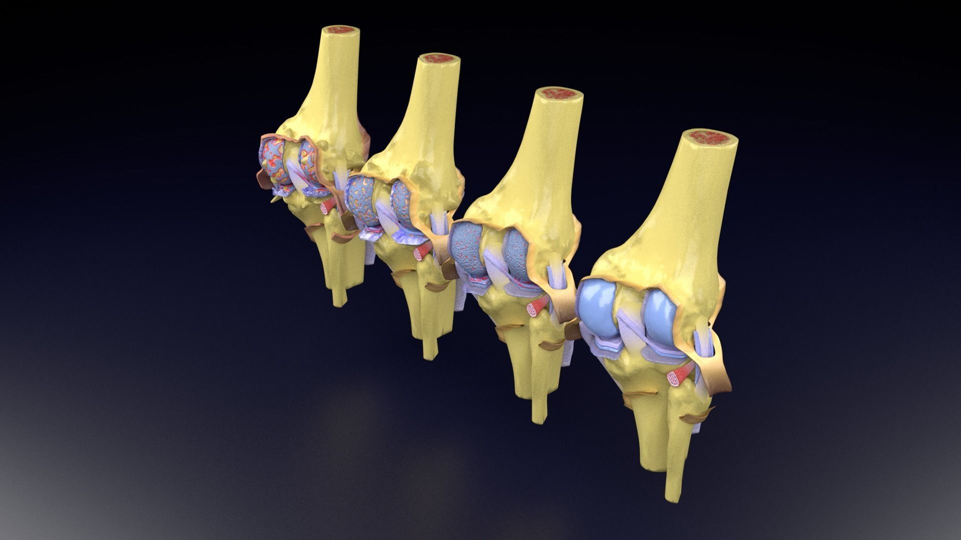 Osteoarthritis stages 3D model_49