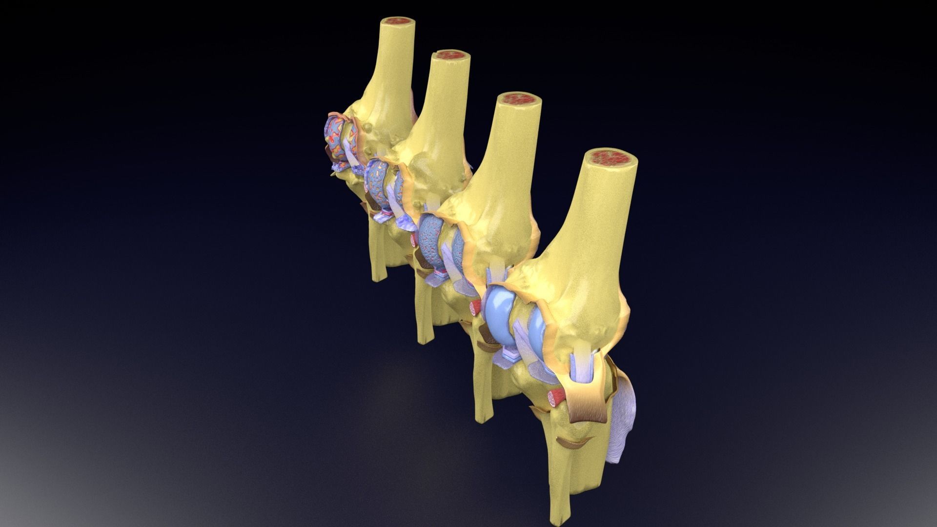 Osteoarthritis stages 3D model_43