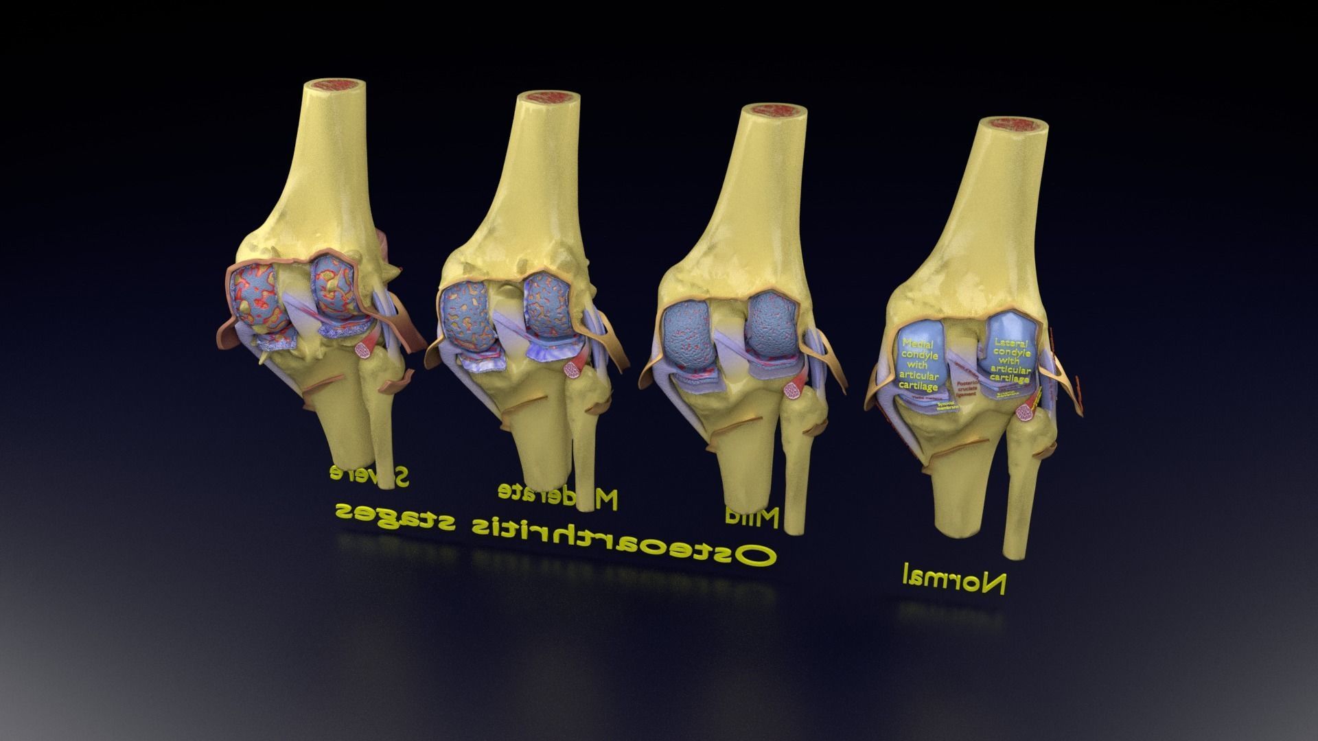 Osteoarthritis stages 3D model_138