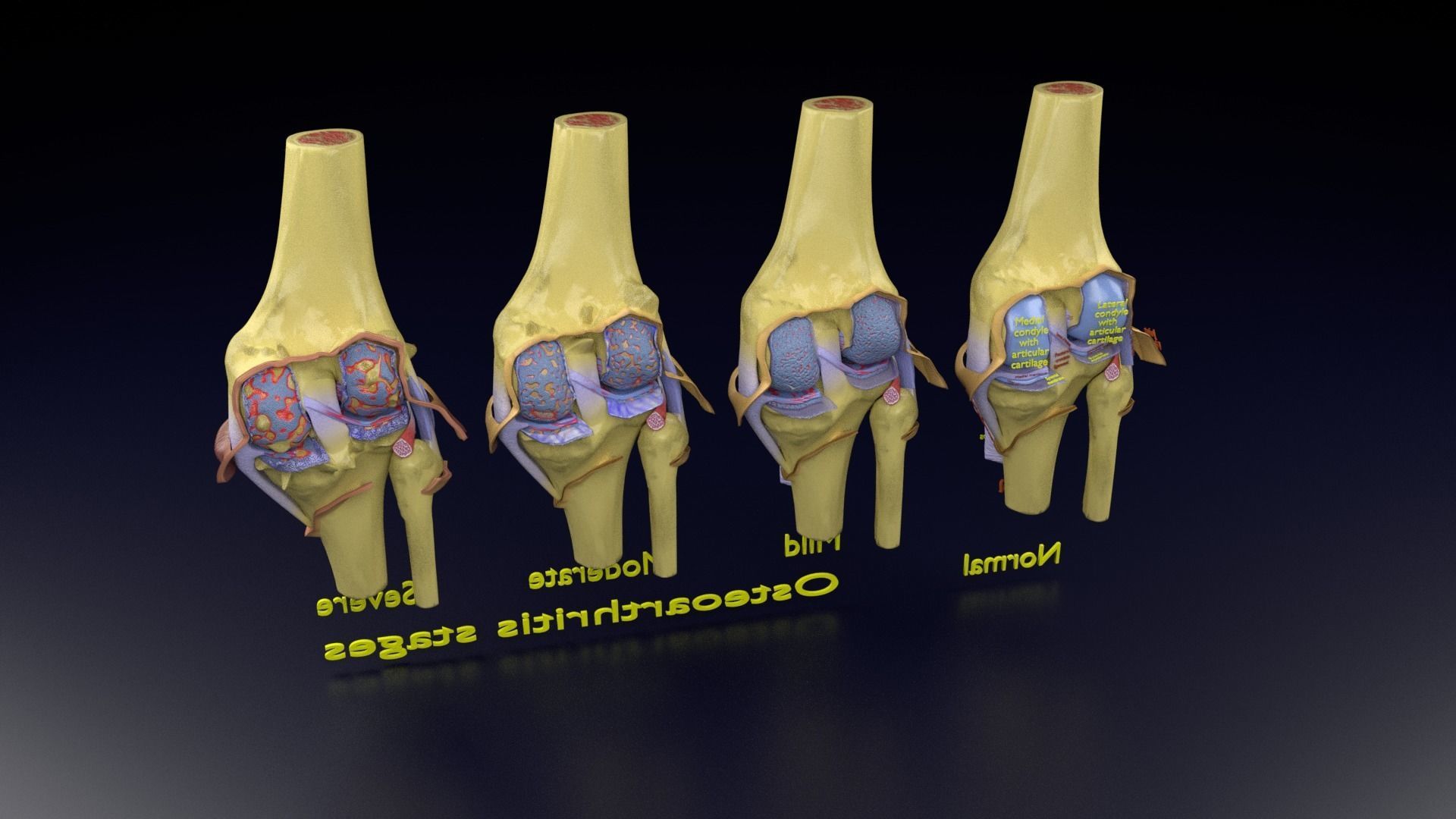 Osteoarthritis stages 3D model_147