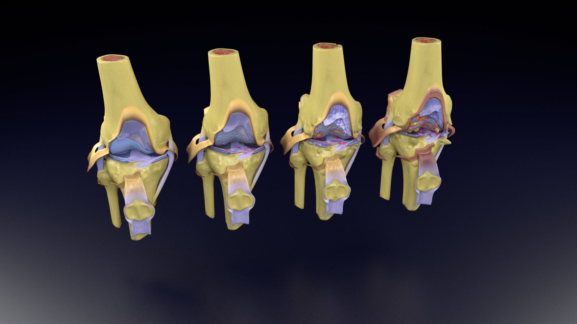 Osteoarthritis stages 3D model_92