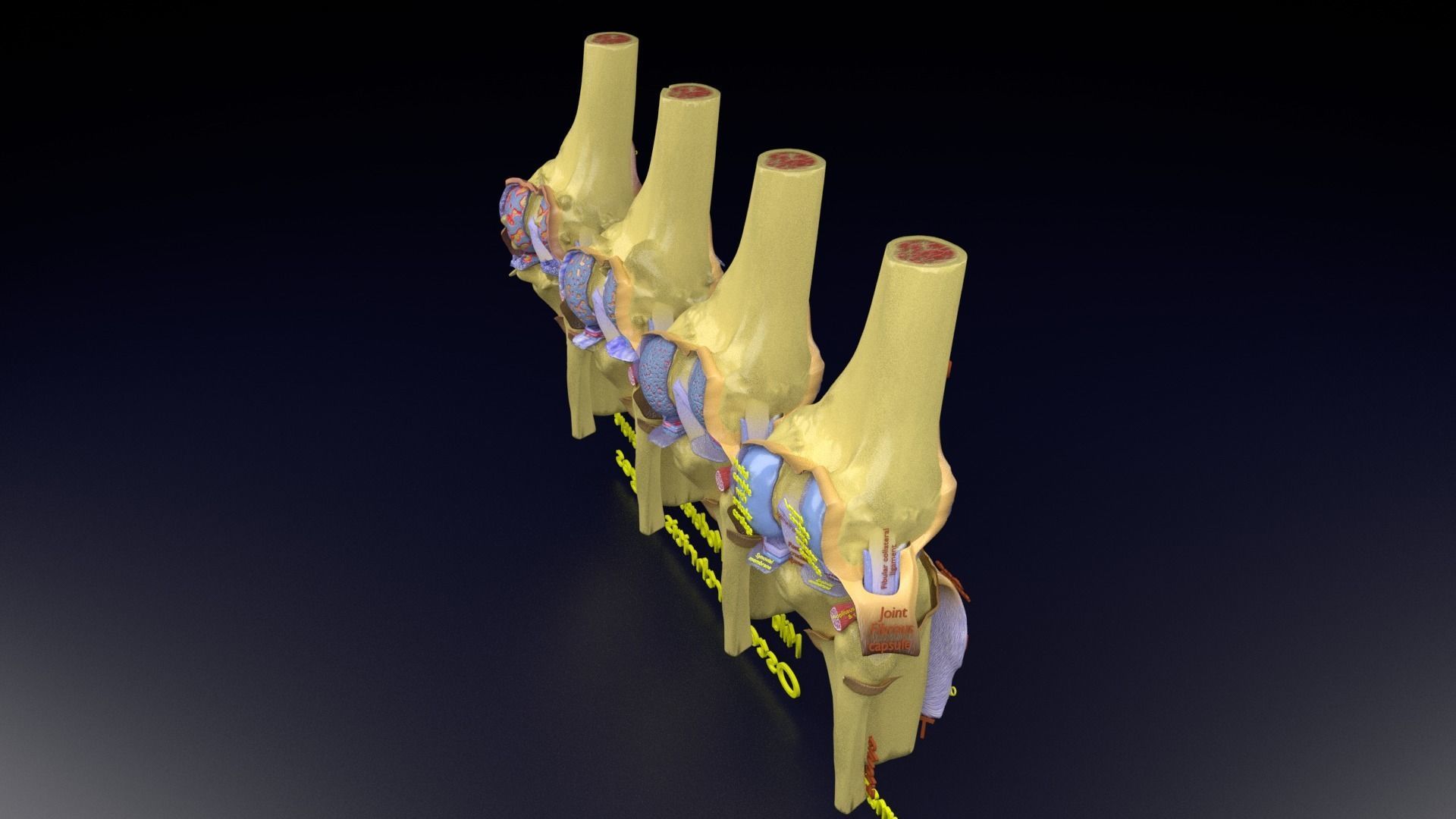 Osteoarthritis stages 3D model_126