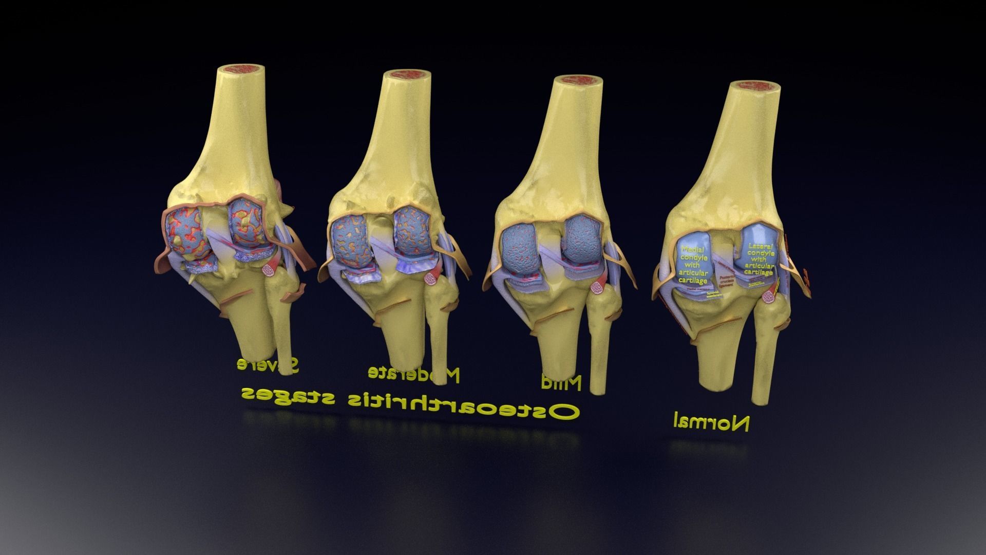 Osteoarthritis stages 3D model_143