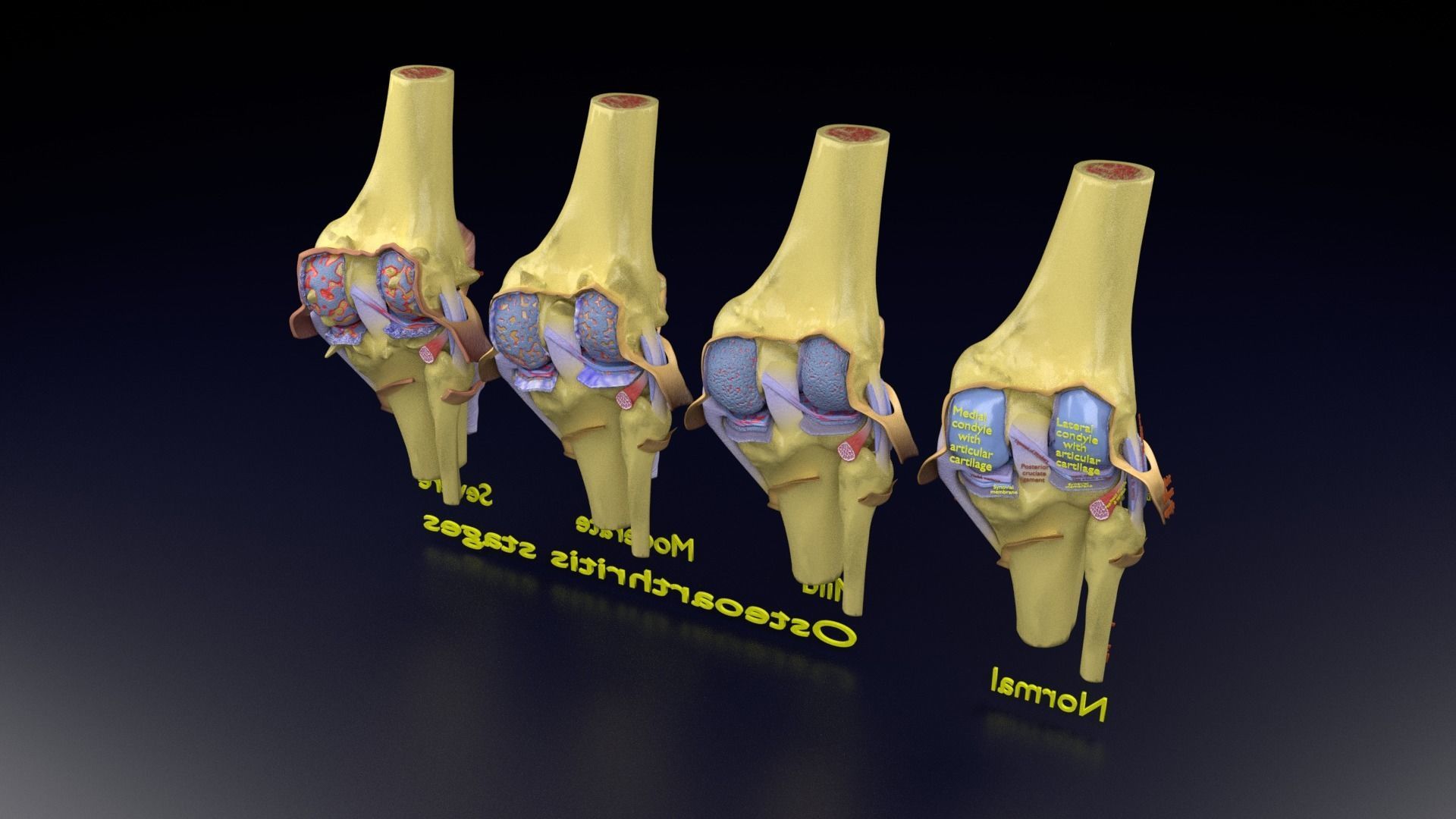 Osteoarthritis stages 3D model_151