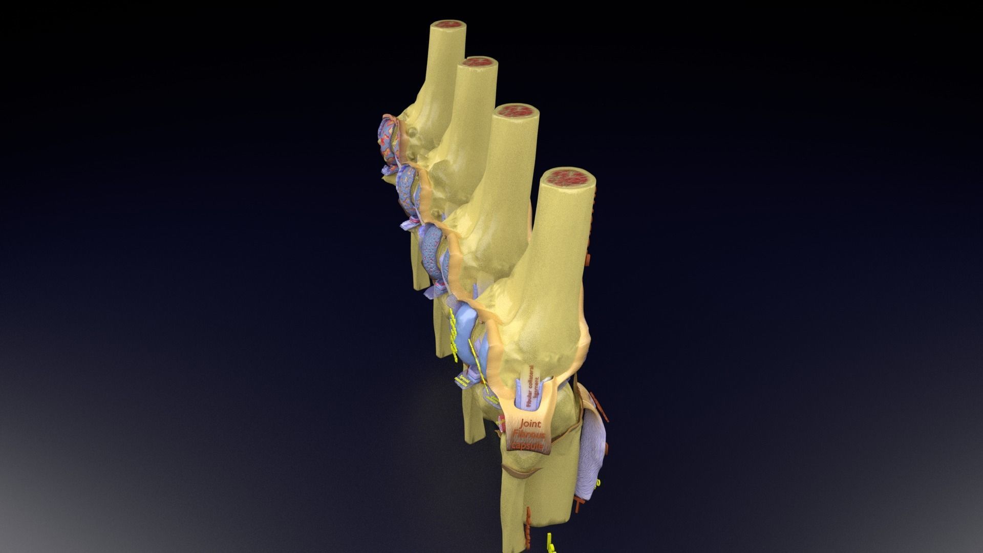 Osteoarthritis stages 3D model_134