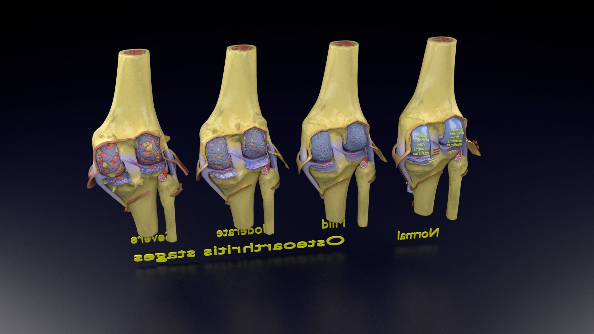 Osteoarthritis stages 3D model_146