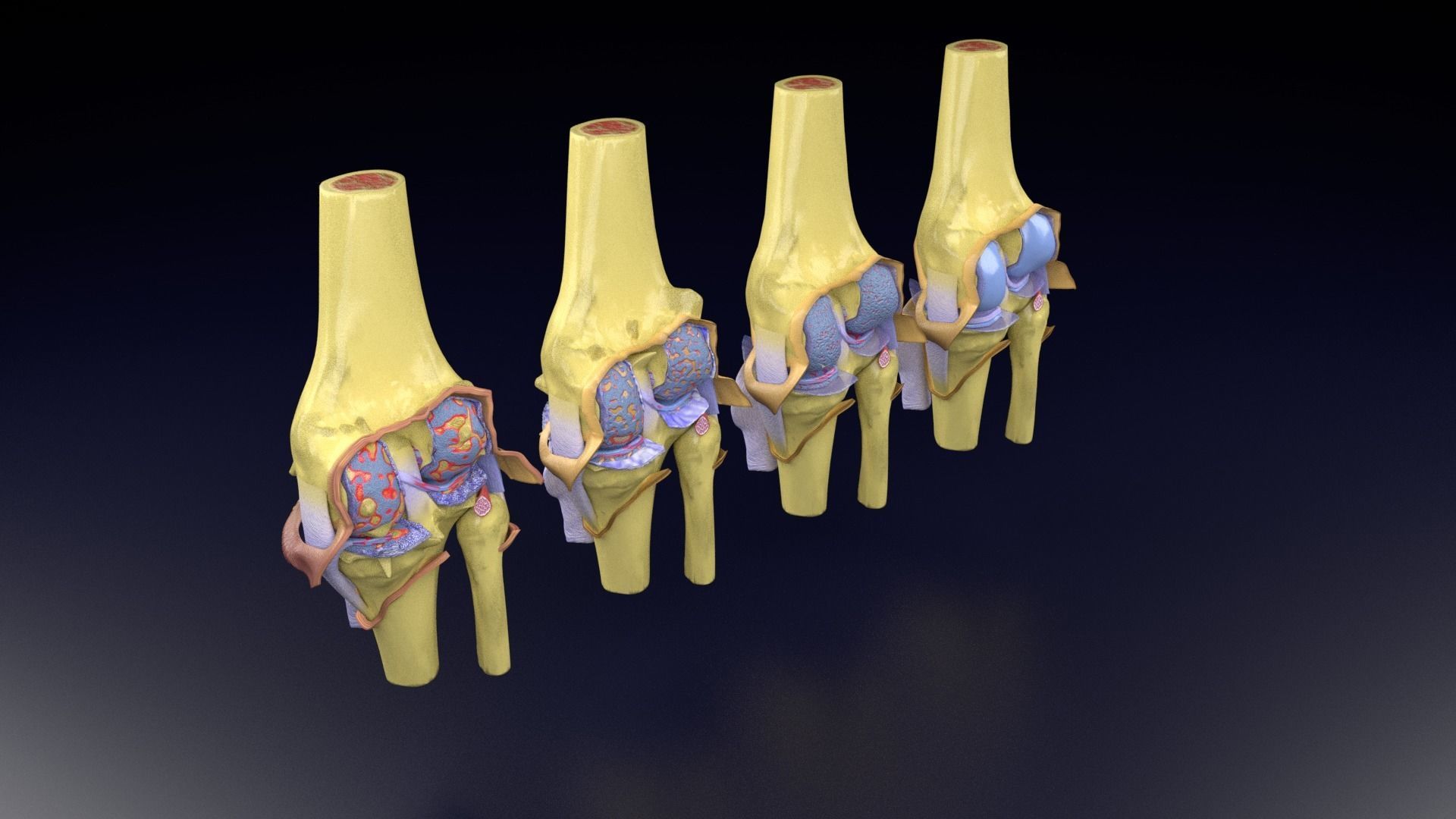 Osteoarthritis stages 3D model_65